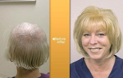 CyberHair and Hair Restoration Techniques | Stylistics Inc. CyberHair and Hair Restoration Techniques | Stylistics Inc.