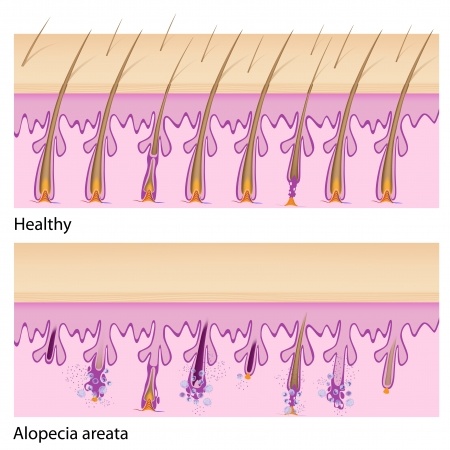 alopecia areata hair follicles